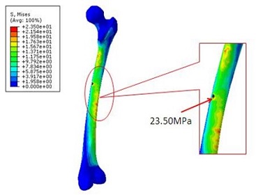 内固定后的骨折类型股骨的最大Mises 应力.jpg
