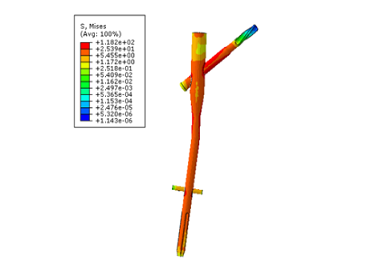 骨折类型内固定的最大Mises 应力.png